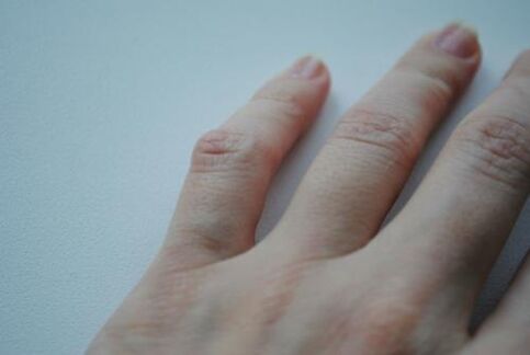 Na malom prstu pojavila se artritična kvržica. 