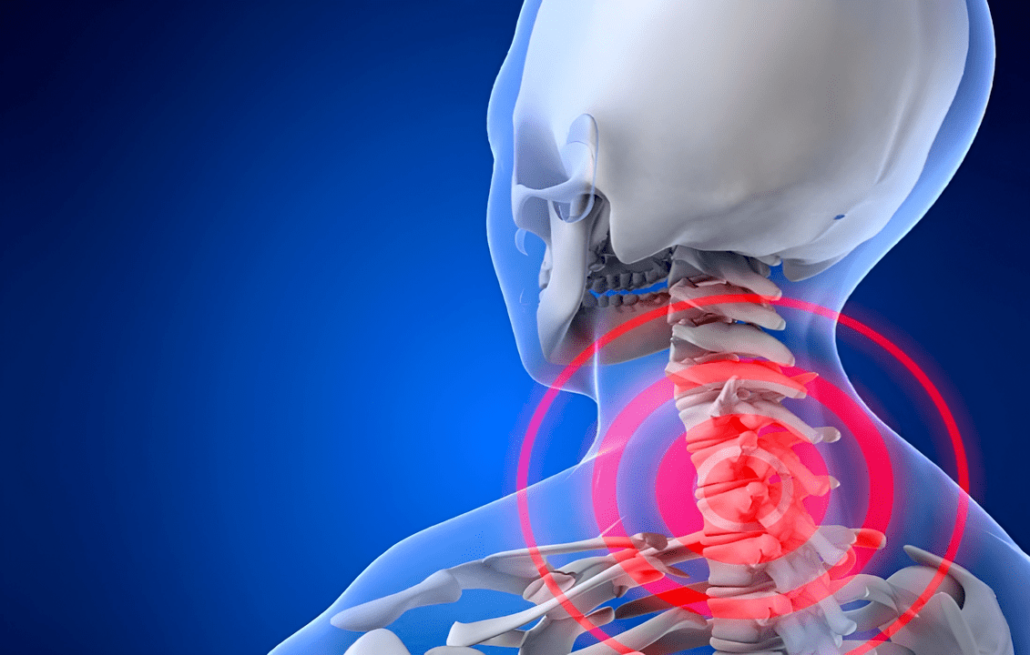 osteohondroza vratne kralježnice