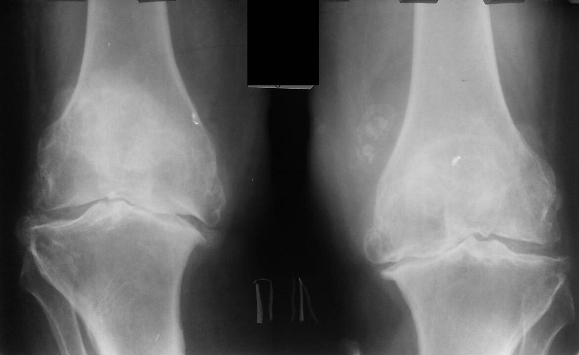 RTG zglobova koljena s artrozom