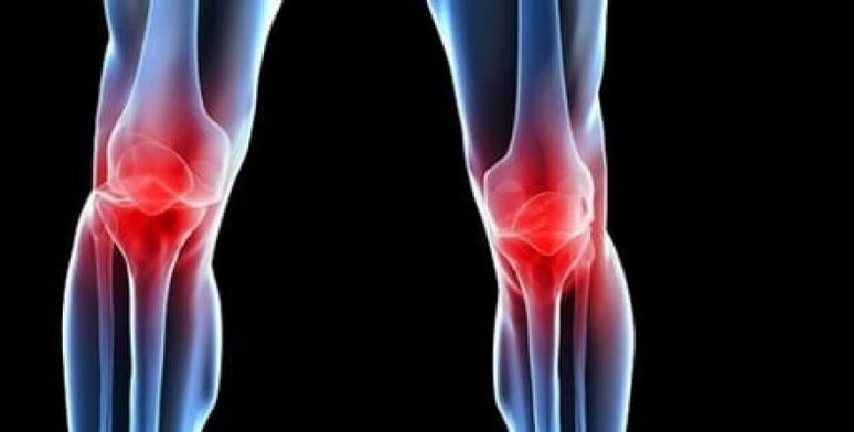 osteoartritis koljena
