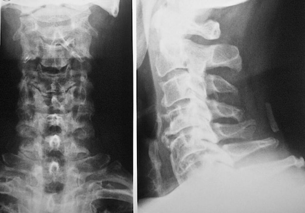 rentgen vratne kralježnice s osteohondrozo