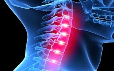 Simptomi osteohondroze kralježnice grlića maternice