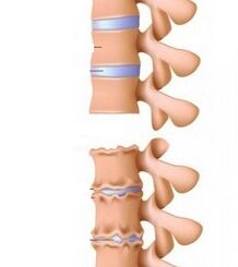 Faze rampe osteohondroze vrata
