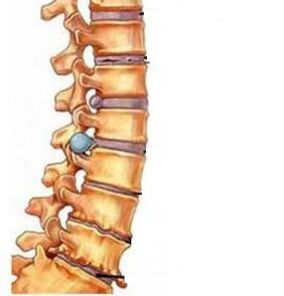 Kako se razvija osteohondroza cervikalne regije