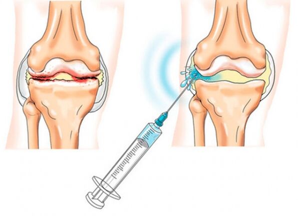 intraartikularne injekcije za artrozu koljena