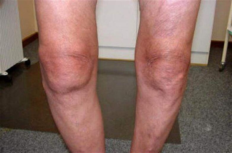 natečeno koljeno zbog artritisa