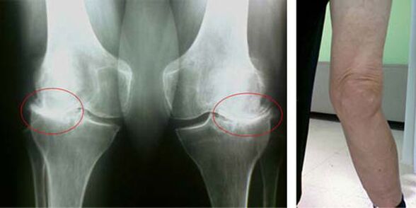 rendgenski snimak osteoartritisa koljena