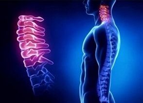 Razlozi razvoja cervikalne osteohondroze