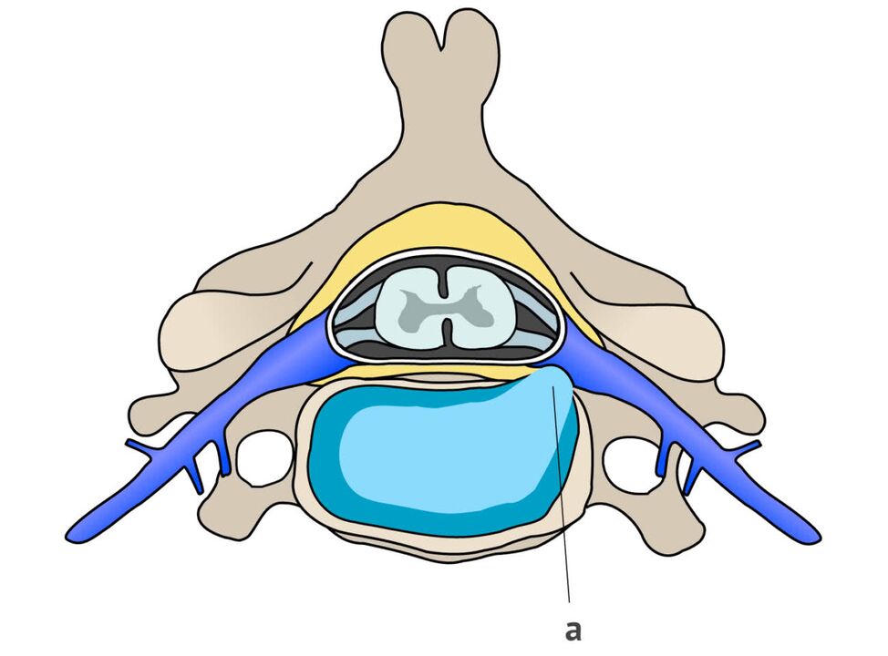 intervertebralna kila s cervikalnom osteohondrozom