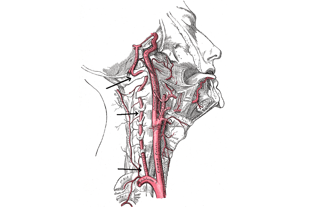 kompresija vertebralne arterije s cervikalnom osteokondrozom
