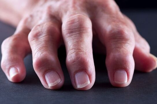 Deformacije zglobova prstiju zbog artroze ili artritisa